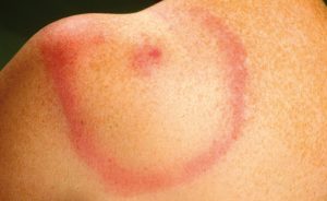 Een duidelijke rode kring of vlek (erythema migrant) is het bewijs voor een Lyme besmetting.